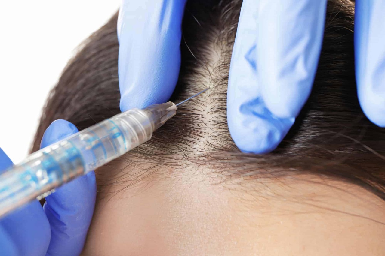 Get the Best Hair Transplant UK Experience with Expert Surgeons