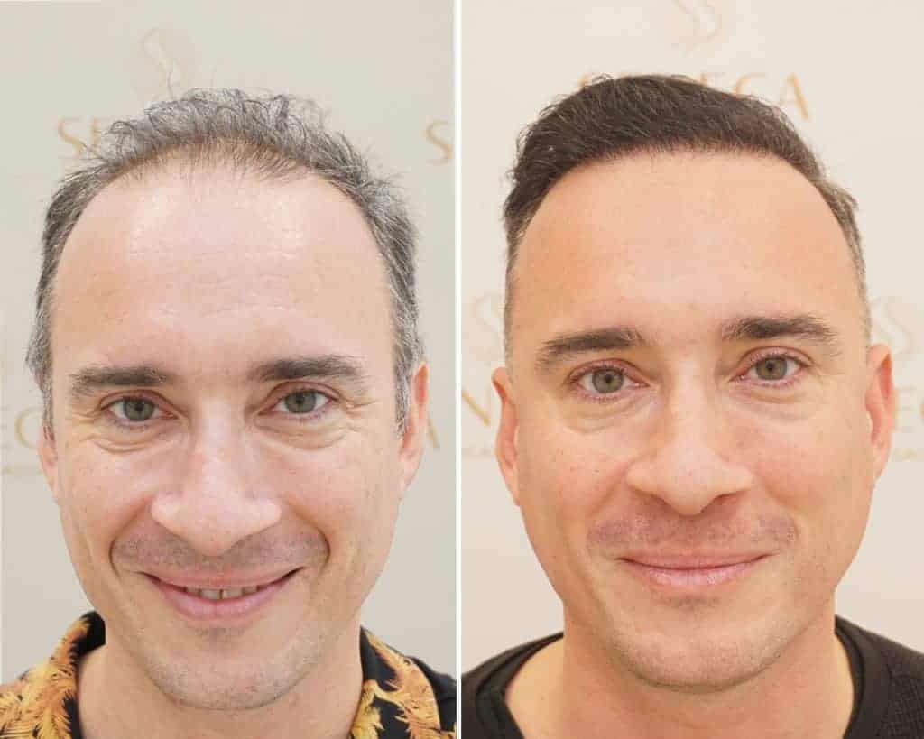 Hair Transplant UK – Advanced FUE &amp; FUT Procedures Explained