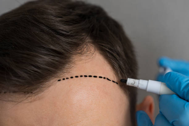 How Much Is Hair Transplant in Turkey vs Europe?